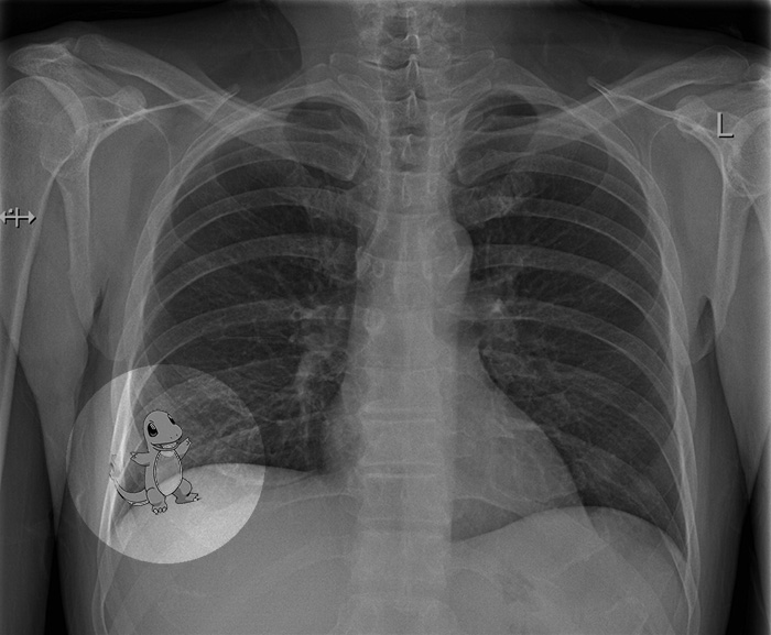 Radiologist Misses Right Lower Lobe Pokémon on Chest X-Ray