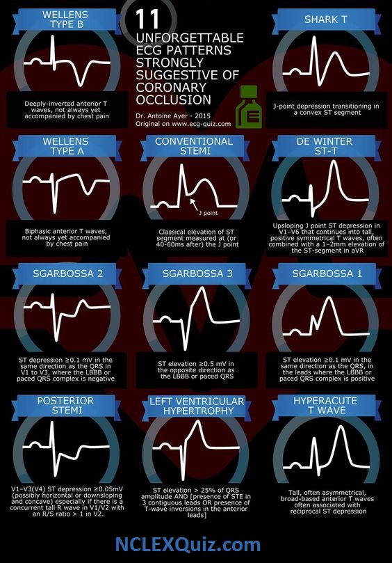 EKG Infographics