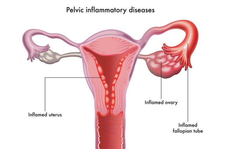 Pelvic inflammatory diseases illustrated in anatomical form on white.