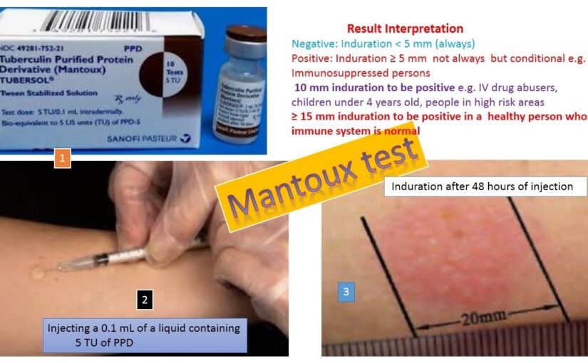 NCLEX Practice Quiz on Tuberculin (Mantoux) Skin Test for Tuberculosis (TB)