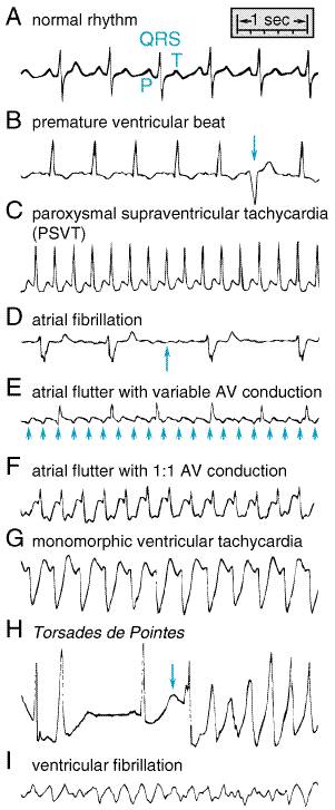 Heart Rhythms Made Easy