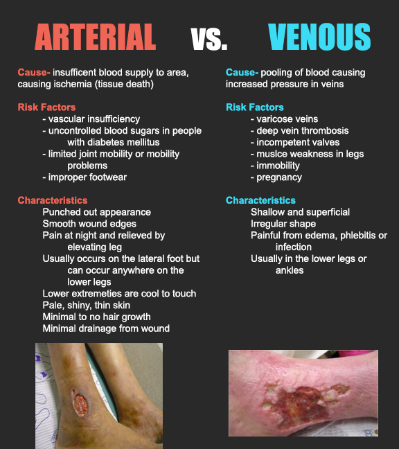 Arterial vs Venous Ulcers