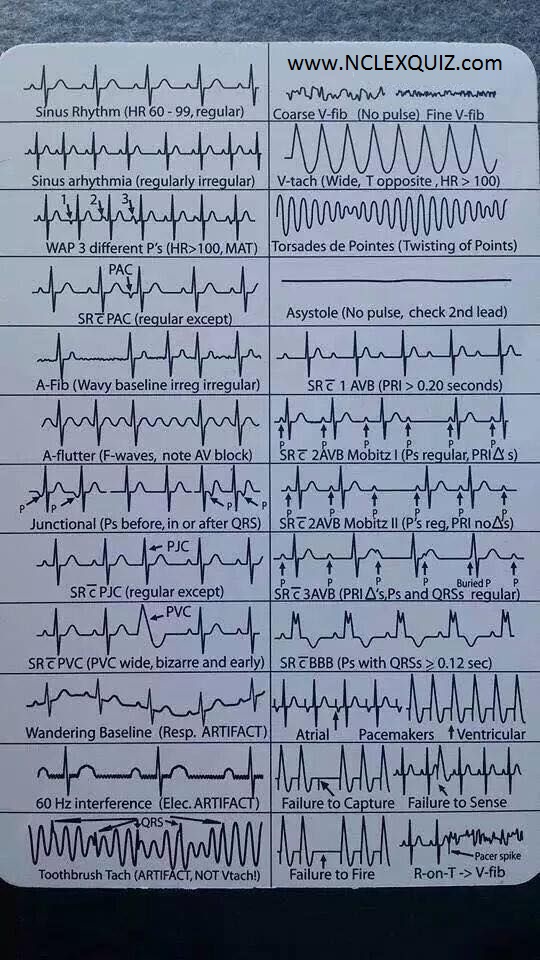EKG Heart Rhythms Cheat Sheet