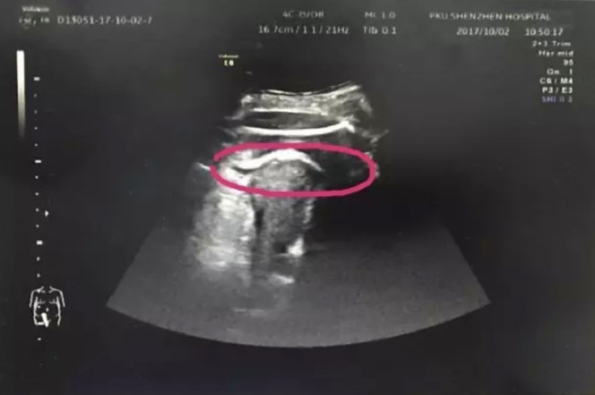 Woman almost dies after unborn baby kicks a hole in her womb