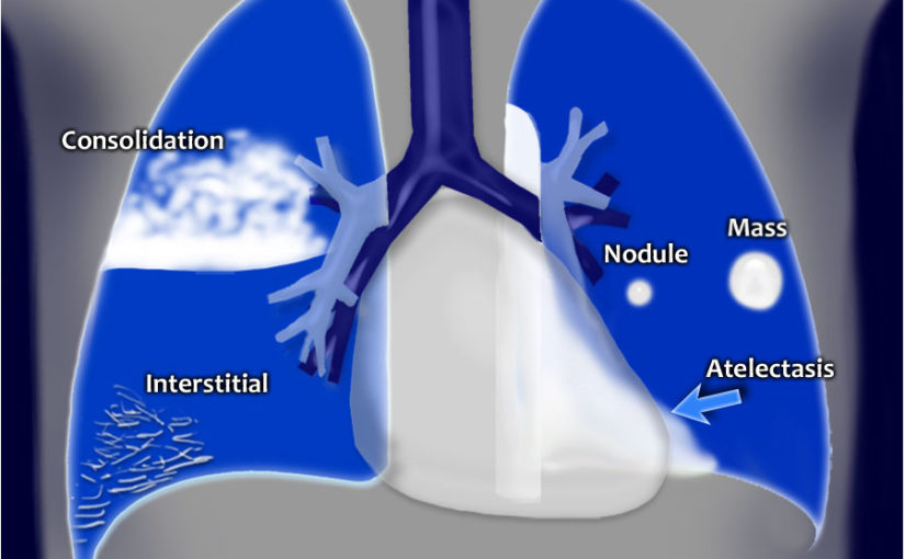 Chest X-Ray: Lung disease Four-Pattern Approach