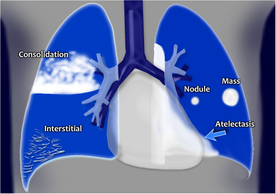 Chest X-Ray: Lung disease Four-Pattern Approach