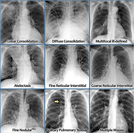 Chest X-Ray: Lung disease Four-Pattern Approach