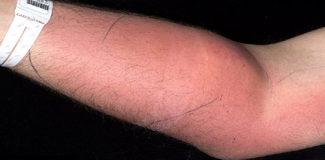 Man injects himself with his own semen to treat back pain