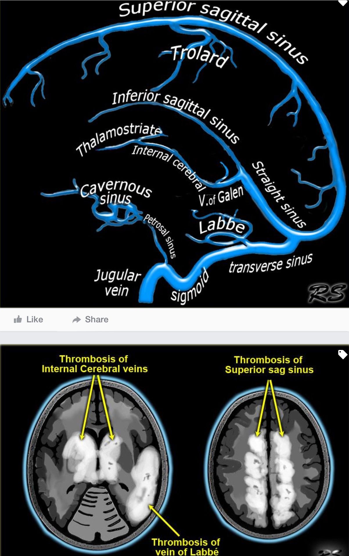 Anatomy of cerebral veins and sinuses - NCLEX Quiz
