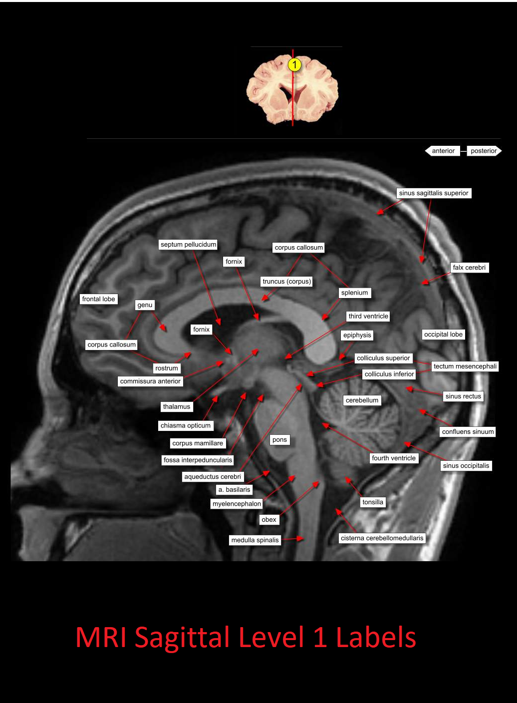 MRI Sagittal Anatomy of Brain Level 1