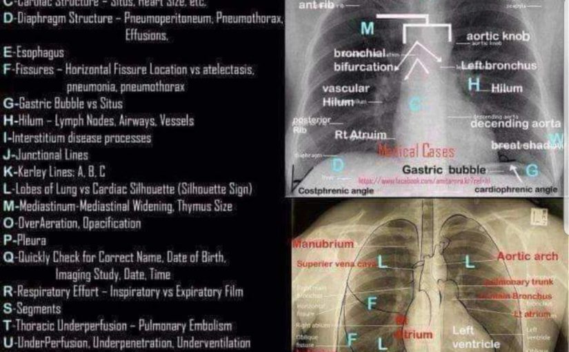 Nursing Mnemonic: How to read a Chest Xray Cheat Sheet