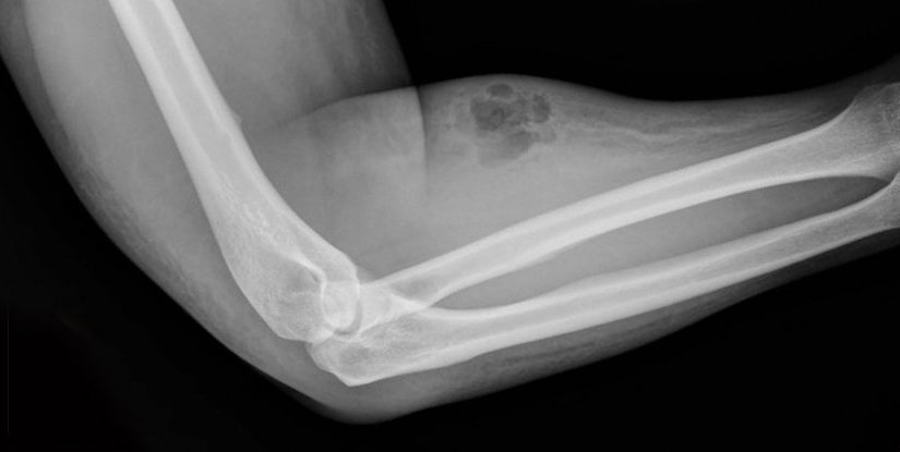 Man injects himself with his own semen to treat back pain