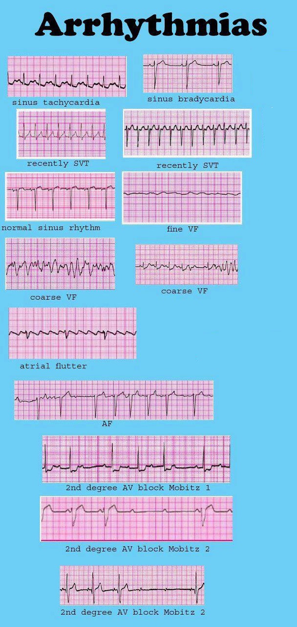 Cardiac Dysrrhythmia (aka Arrhythmia And Irregular Heartbeat) - Electrocardiogram Interpretation