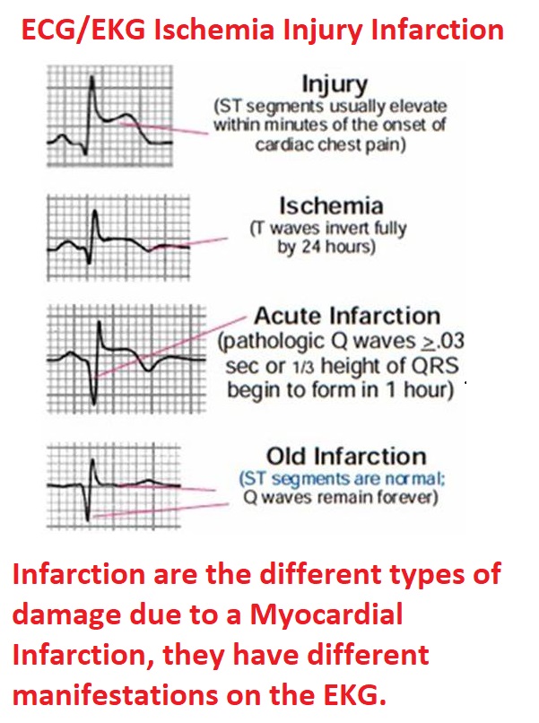 ECG/EKG Ischemia Injury Infarction