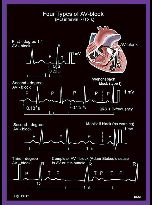 ECG Heart Block Rhythms - Four types of atrio-ventricular (AV)-block