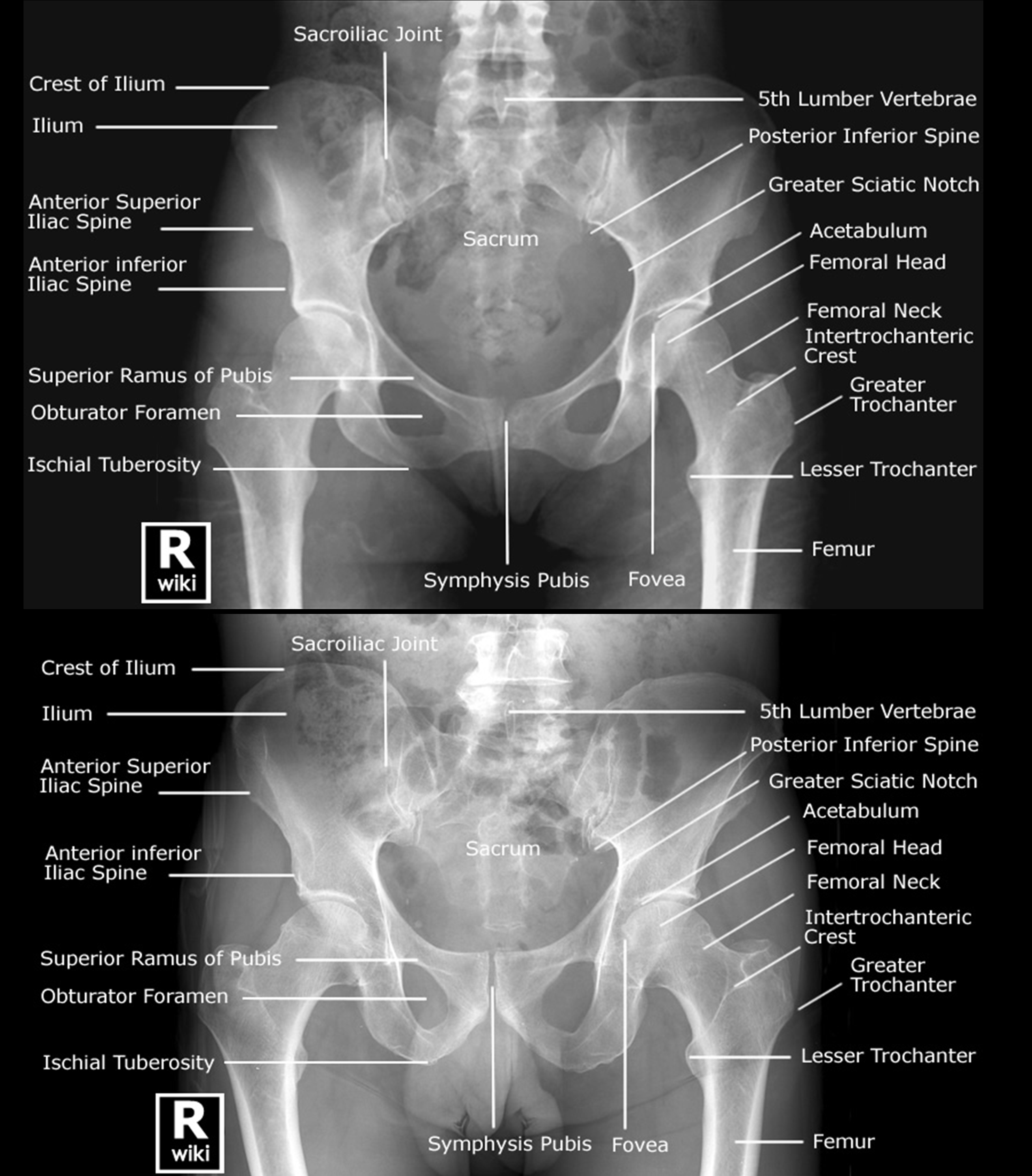 Labeled Radiographic Anatomy & Differences Between Male & Female Pelvis