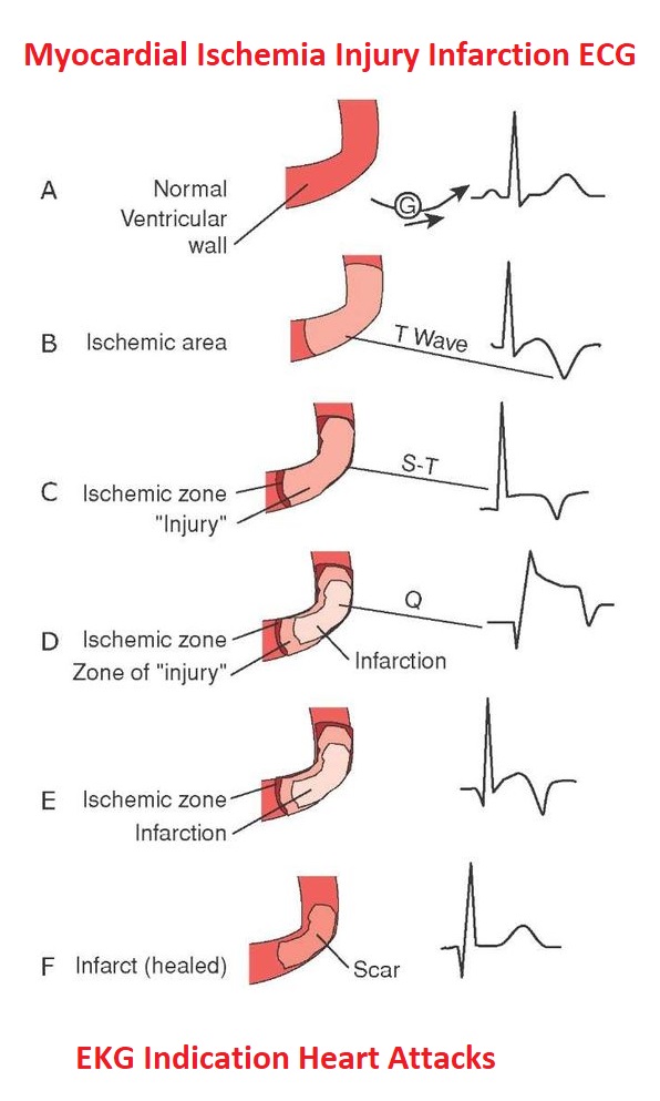 ECG indications of myocardial ischemia, injury, and infarction