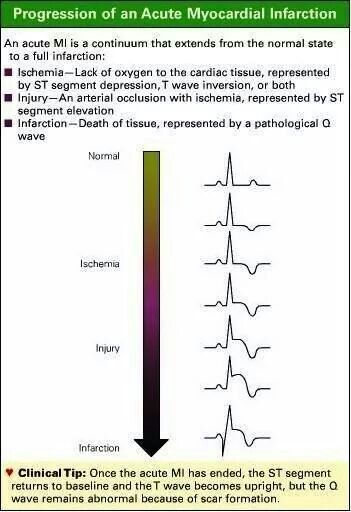 Progression of an Acute Myocardial Infarction