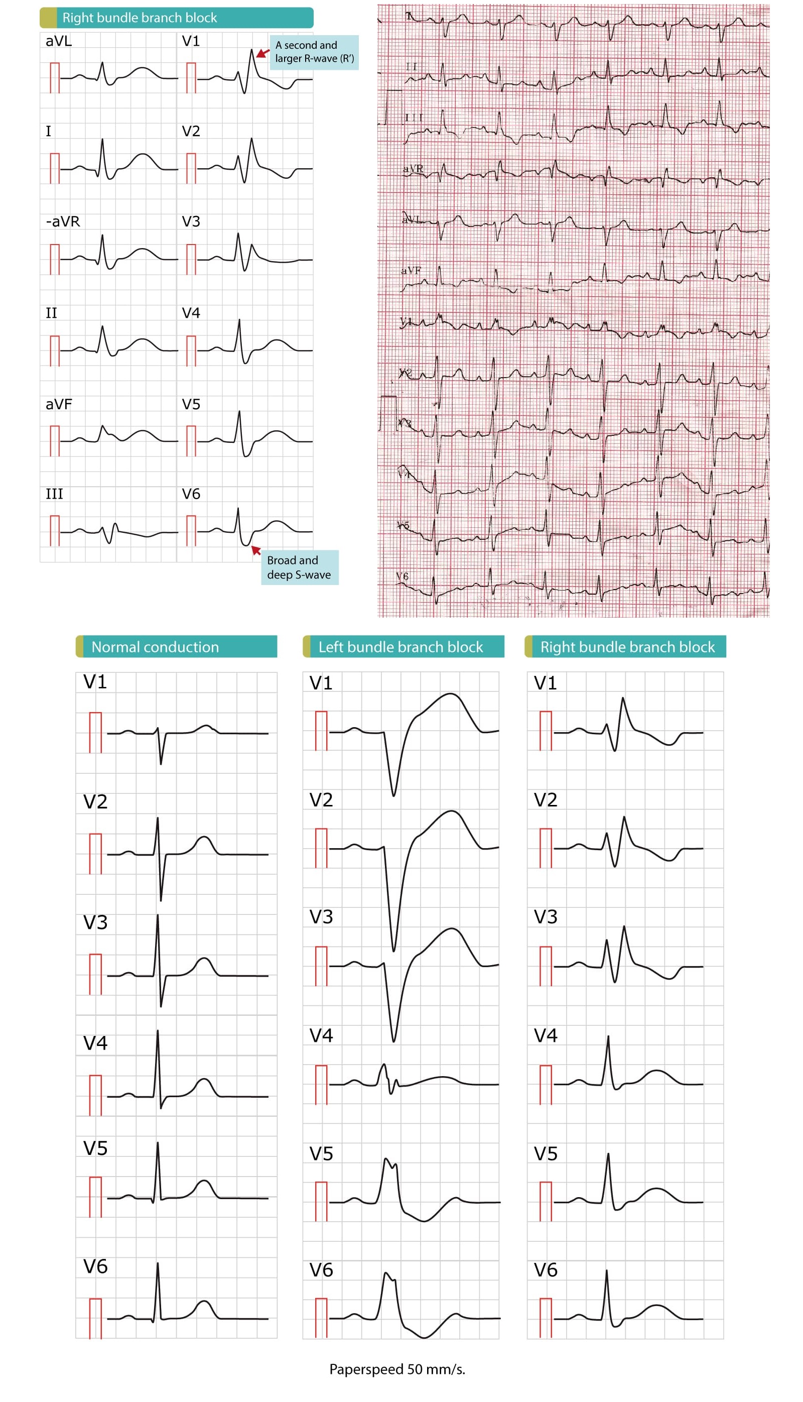 Right Bundle Branch Block RBBB Ecg Criteria Definition