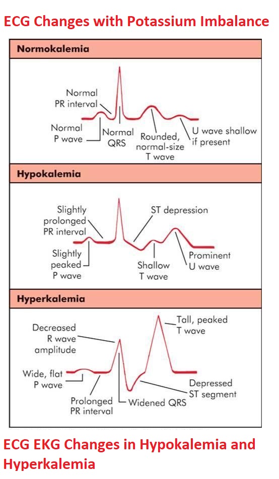 ECG/EKG Changes in Hypokalemia and Hyperkalemia - NCLEX Quiz