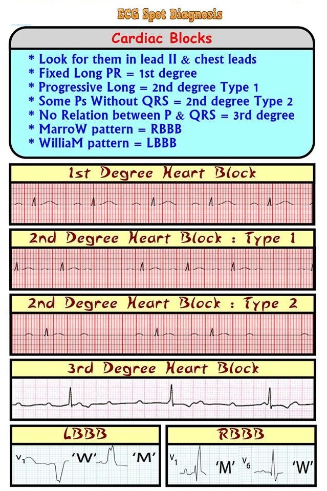 ECG/EKG Spot Diagnosis: Cardiac Rhythms Heart Blocks