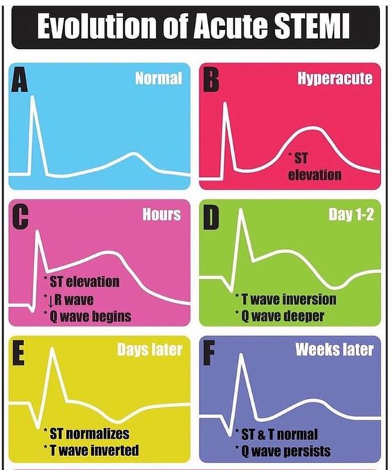 Evolution of Acute STEMI