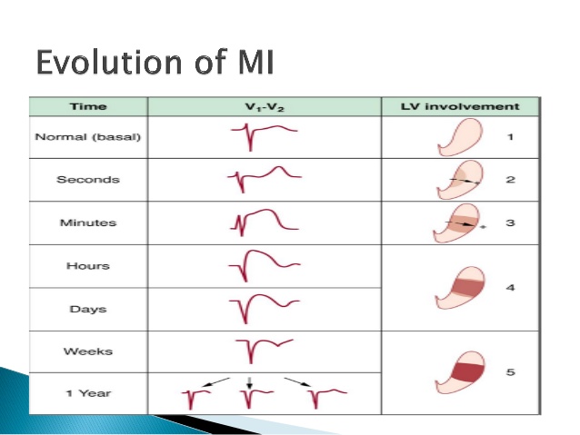 ST-segment depression and T-wave inversion in STEMI