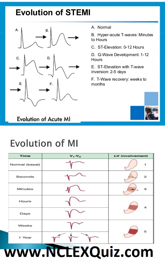 ECG Changes in Myocardial Infarction