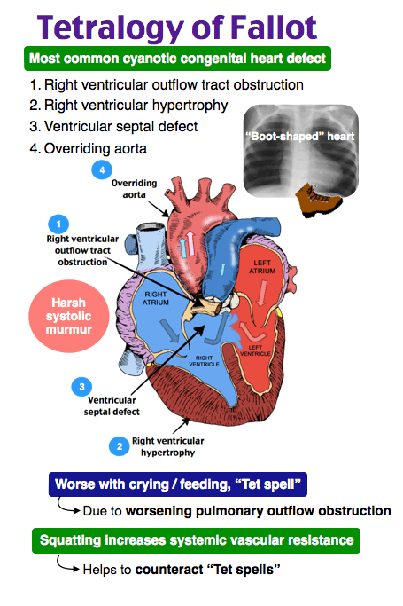 Tetralogy of Fallot Rapid Review For Nursing Students