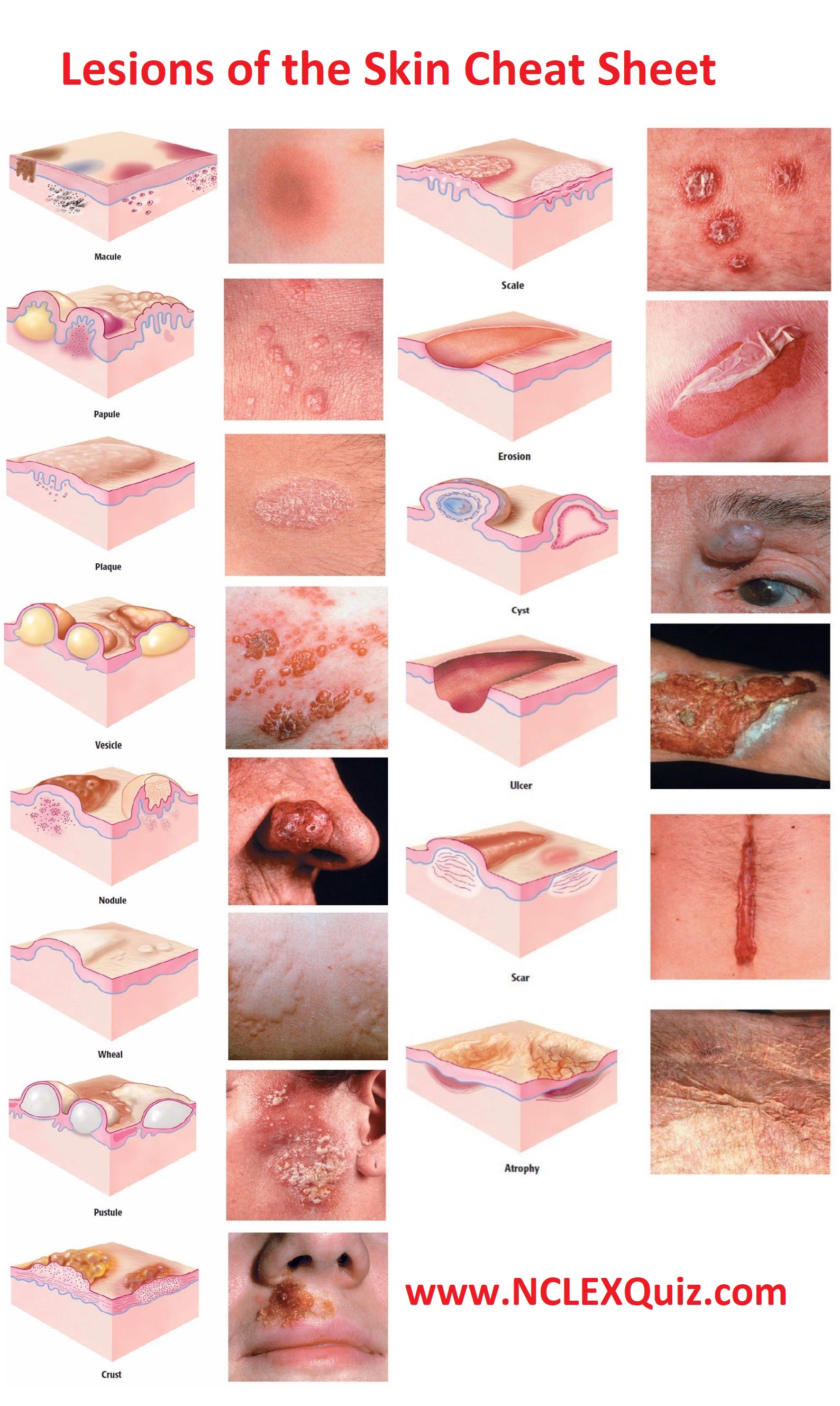 Nursing Dermatology: Lesions of the Skin Cheat Sheet