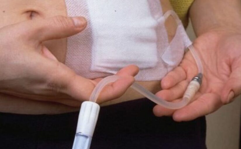 NCLEX Practice Quiz: Prioritizing Asepsis in Peritoneal Dialysis Administration