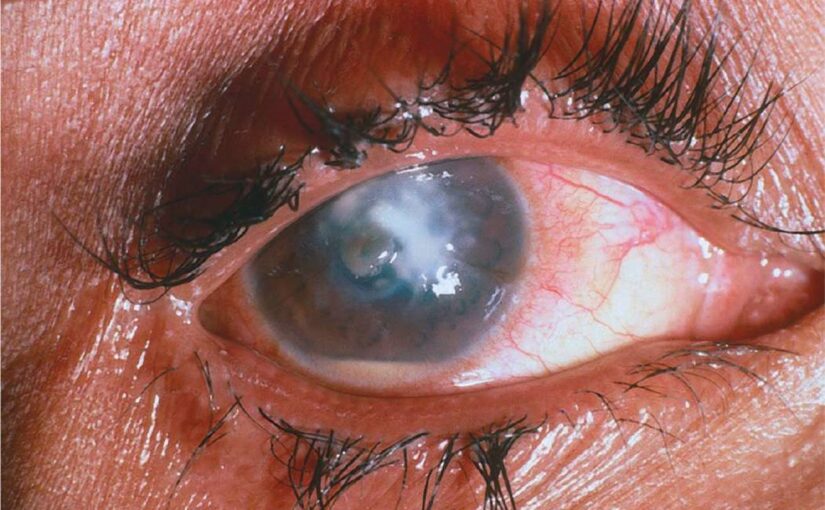 Effective Eye Management: A NCLEX Practice Question on Dry and Irritated Cornea