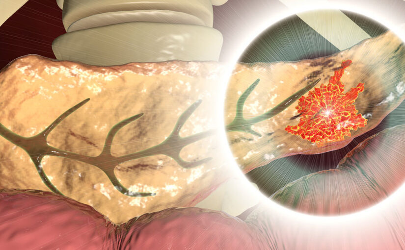 Diagram representing a NCLEX practice quiz for prioritizing patient needs in pancreatic cancer