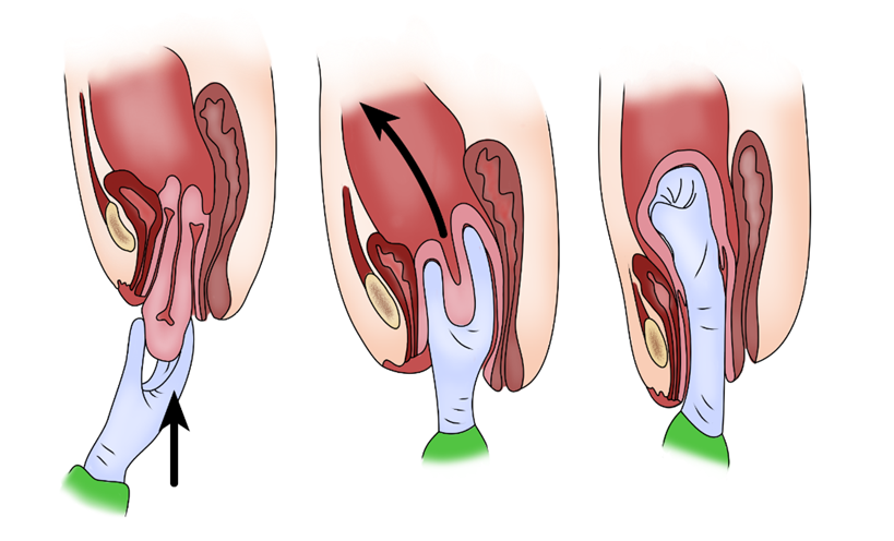 Postpartum Lochia: Understanding the Stages and Characteristics