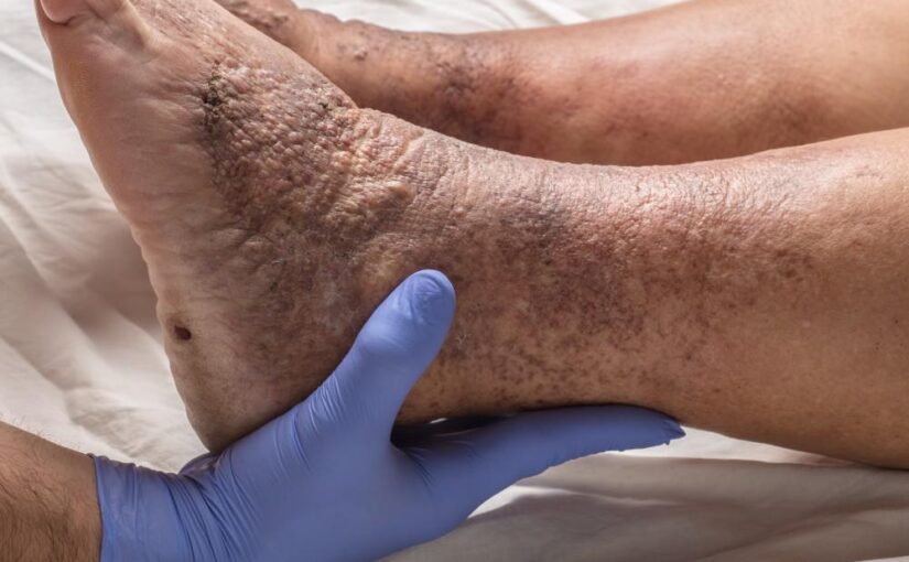 The Mystery of Heparin in DVT Treatment A Tricky NCLEX Quiz