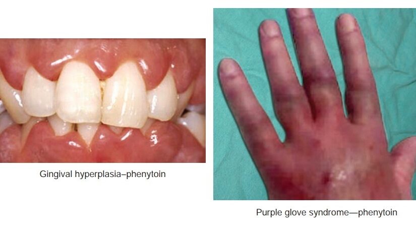 NCLEX-RN Exam Based Practice Questions with Rationale: Monitoring Phenytoin Therapy