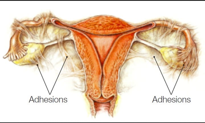 NCLEX Practice Quiz: Uterine Adhesions and Terminology