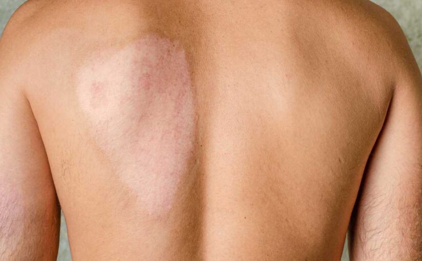 Porcine Grafts in Burn Treatment