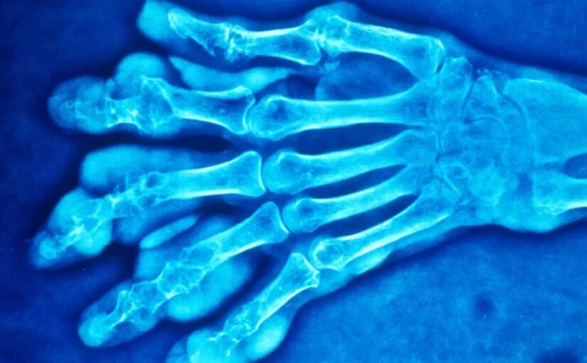 NCLEX Practice Quiz on Allopurinol and Client Concerns in Gout