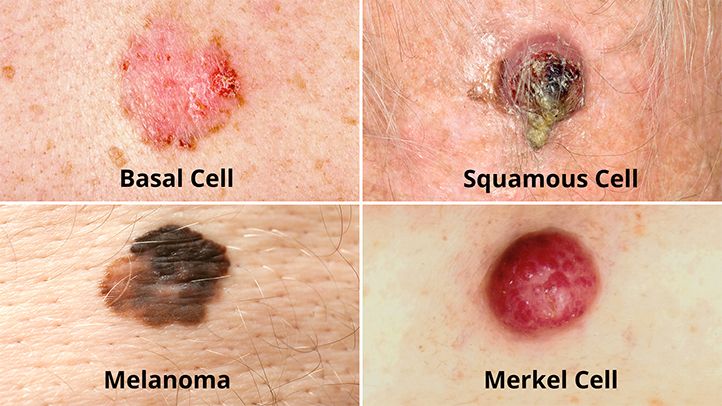NCLEX Practice Quiz: Medication for Merkel Cell Carcinoma Treatment