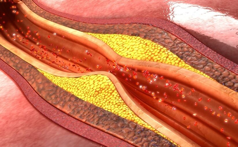 Atherosclerosis Risk Reduction Strategies