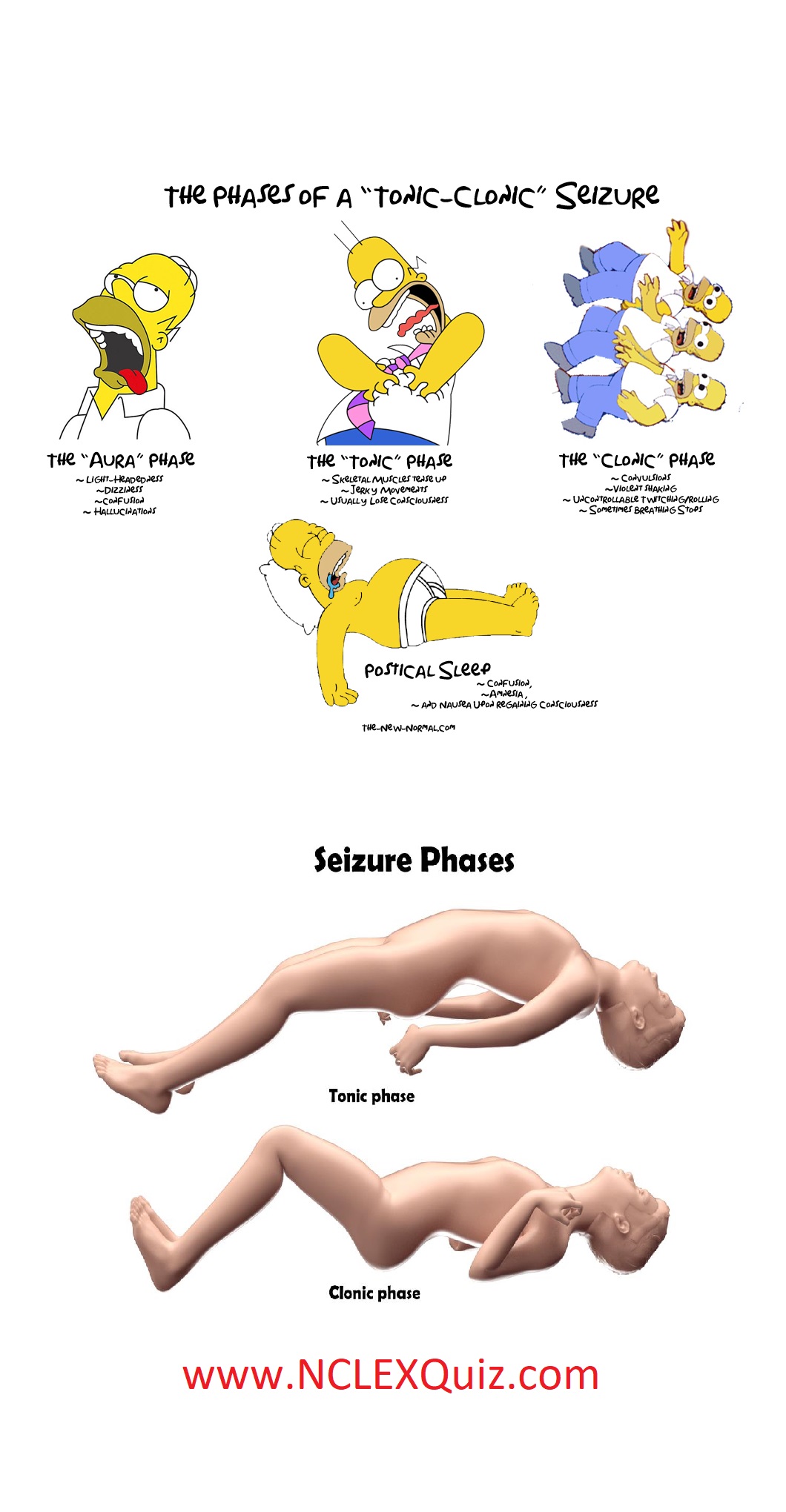 The 4 Stages of a Seizure