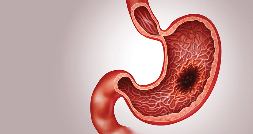 NGN Quiz: Assessment in Gastric Cancer Home Care